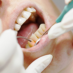コンセプト5 “一口腔単位”での治療