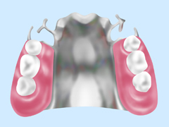 金属床義歯/自費診療
