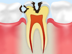 C2　象牙質のむし歯