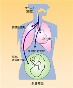 歯周病がもたらす全身への影響